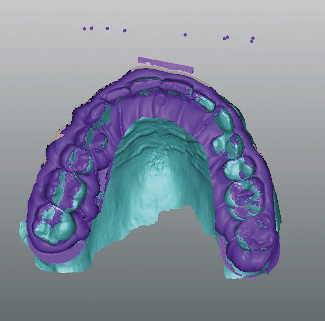 Abb. 11: Überlagerung von Intraoralscan und Abformscan.