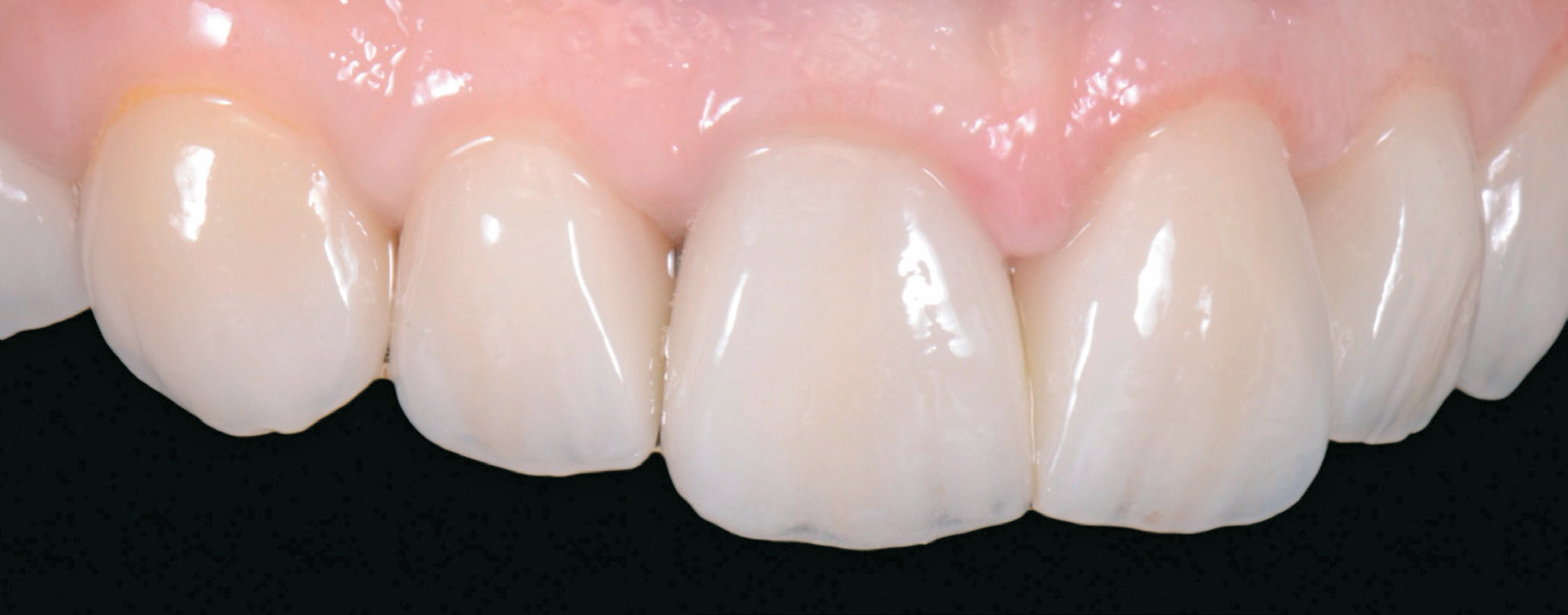 Abb. 16: Situation nach 4 ½ Jahren. Die Aufnahme zeigt die Langlebigkeit, Farbstabilität und das gesunde Weichgewebe der vier Kronen und zwei Veneers.
