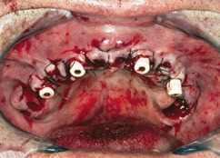 Abb. 17: Abschluss der OP im OK, eingebrachte healing caps.