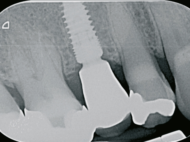 Abb. 20: Röntgenkontrollbild. Sichtbar ist das Knochenwachstum über die Implantatschulter, dank subkrestaler Platzierung des SICvantange und dessen Geometrie.