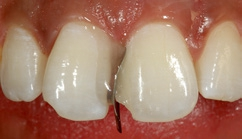 Abb. 17: Dentinmasse D1 im palatinalen Bereich des Zahnes 21.