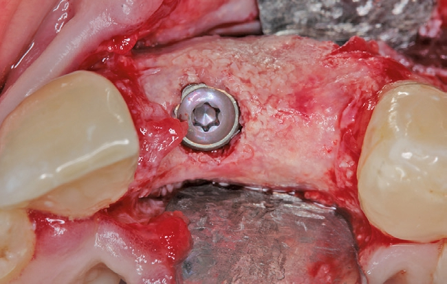 Abb. 16b: Das Implantat in korrekter Position.