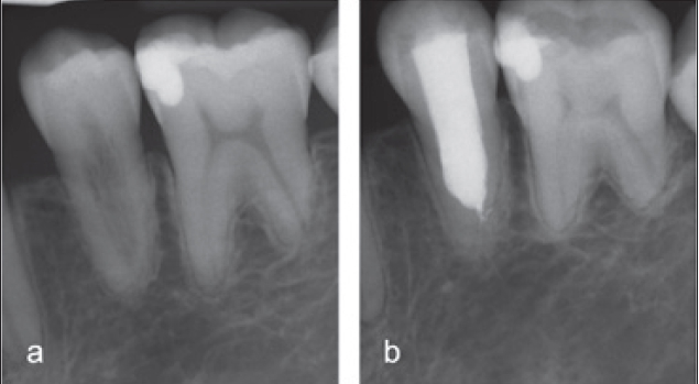 Abb. 16 a u. b: Interne Ersatzresorption an Zahn 45. Nach Entfernung des Granulations- und Reparaturgewebes wurde der Wurzelkanal mit MTA gefüllt und der Zahn mit einer tiefen adhäsiven Füllung stabilisiert (Röntgenkontrolle nach 3 Jahren).