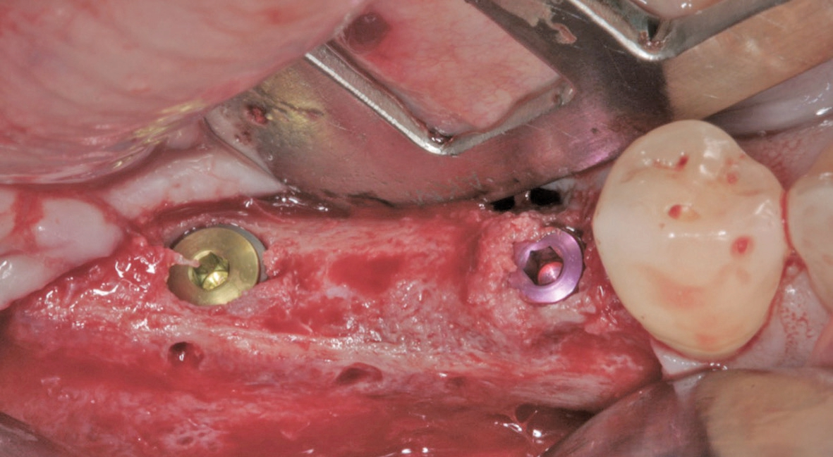 Abb. 18: Die Insertion von zwei Implantaten im Unterkiefer rechts.