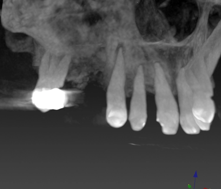 Abb. 17d: Nebenbefund DVT mit Aufhellung 13,12. Es folgt eine endodontische Therapie.