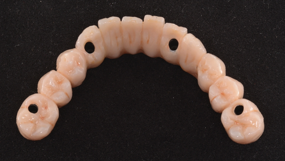 Abb. 19a: Fertig mittels Komposit verblendete Brücke.