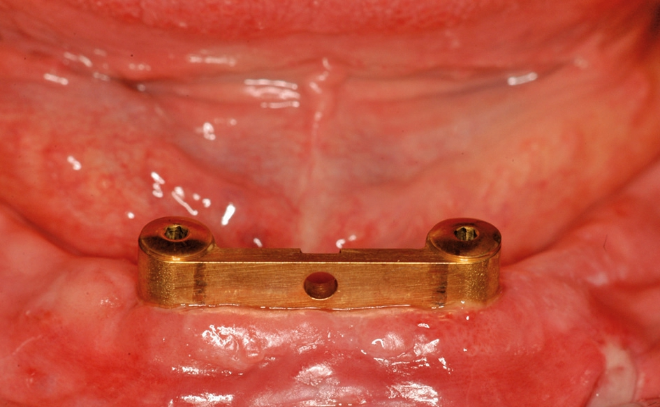 Abb. 18: Klinische Situation am Tag nach der Implantation. Sowohl die Schwellung als auch die Operationswunden sind minimal.