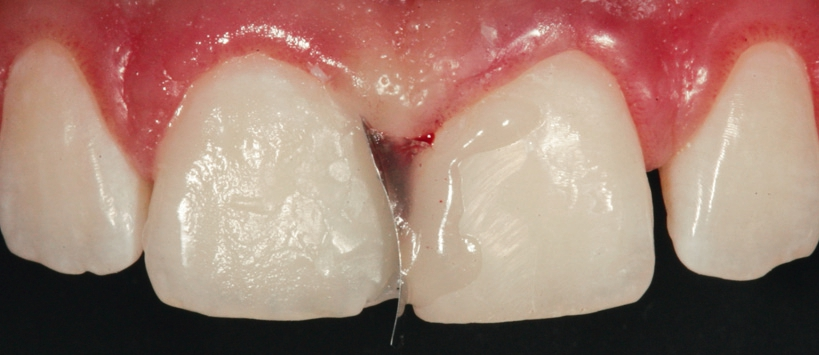 Abb. 18: Überschichtung mit der Dentinmasse D1.