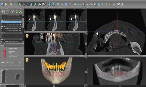 Abb. 18: Planung der Implantatpositionen mit virtueller Aufstellung.
