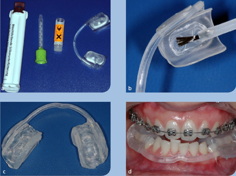 Abb. 16a–d: Vorgefertigter Aquasplint; wird unter dem Einsatz von Monomer an dem jeweiligen Patienten mit Silikonmasse individualisiert. Dieses Gerät kann auch in Kombination mit Brackets eingesetzt werden.