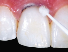 Abb. 18: Zur besseren, unter Sicht stattfindenden Überschussentfernung mit einem Applikationstip bleibt der Retraktionsfaden noch in situ.