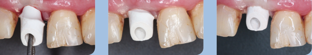 Abb. 23–25: Einsetzen des definitiven Abutments.