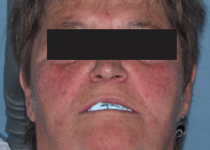 Abb. 17: Markierung der Ästhetiklinien.