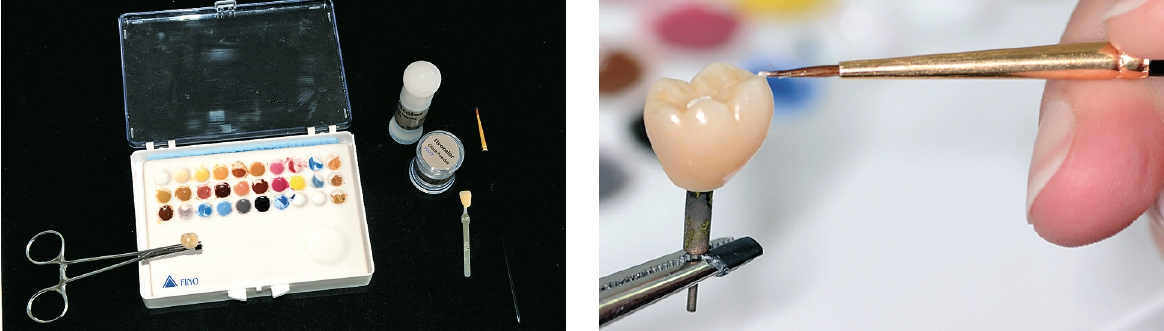 Abb. 17 u. 18: Charakterisierung der keramischen Krone mit dem universellen Malfarben- und Glasursortiment IPS Ivocolor.