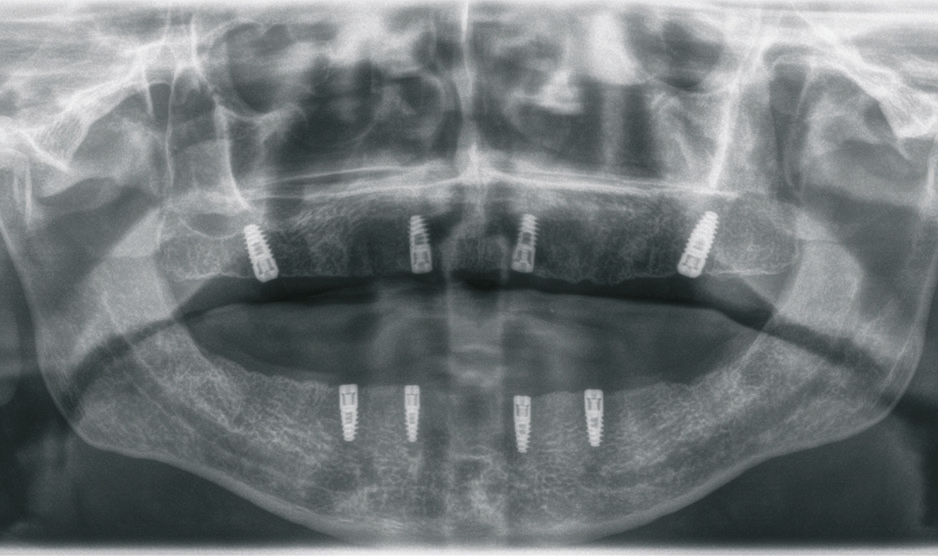 Abb. 18: OPG nach der Implantation.