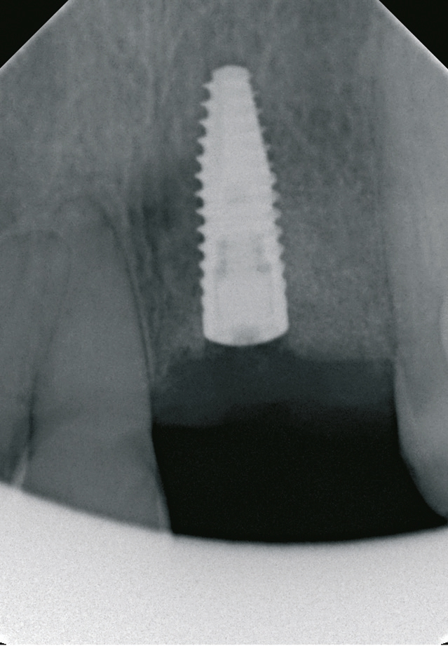 Abb. 17: Röntgenkontrolle nach der Implantatinsertion.
