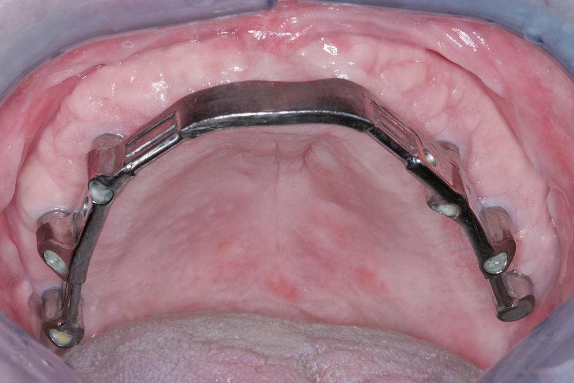 Abb. 16b: Der intraoral eingegliederte CAD/CAM-Steg und die periimplantär gut verheilte keratinisierte Mukosa-Manschette für langfristig stabile Verhältnisse.