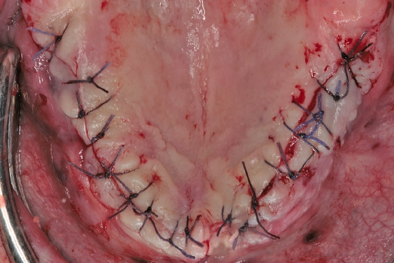 Abb. 16: Spannungsfreie Naht zur geschlossenen Einheilung der Implantate im Oberkiefer.