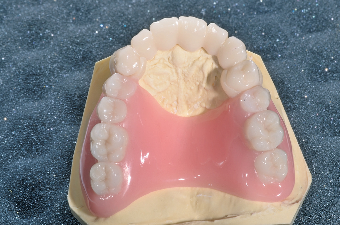 Abb. 18: Das Provisorium: final bearbeitete Brücke mit den zahnfarbenen Klammern aus Acetal und der Prothesenbasis aus Sonderkunststoff auf dem Modell.