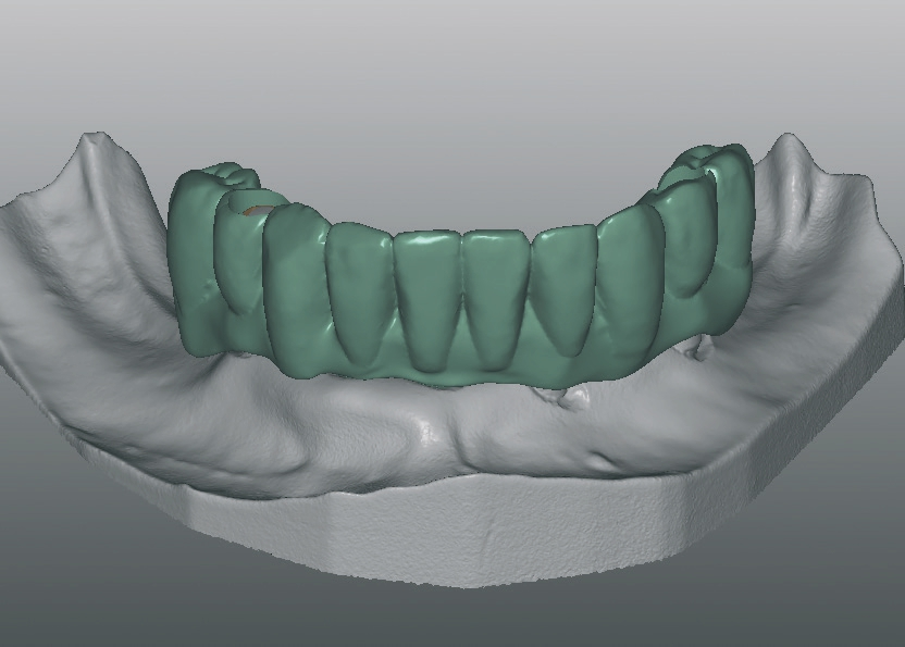 Abb. 10c: Bearbeitung des Gingiva-Designs (Reduktion).