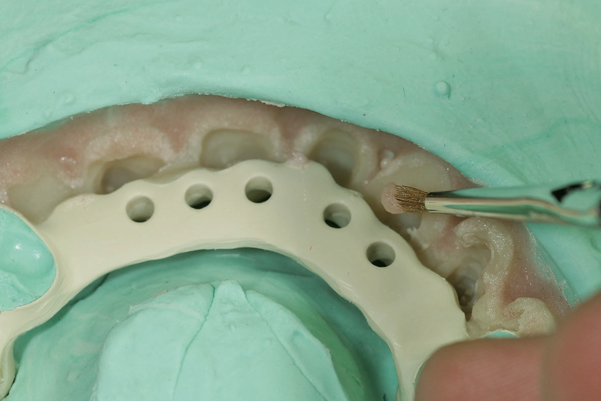 Abb. 21: Die künstliche Gingiva wurde aus Candulor Aesthetic Heißpolymerisat hergestellt und mittels Candulor Aesthetic Color Set individualisiert (Candulor, Rielasingen-Worblingen).