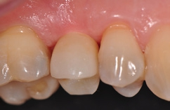 Abb. 19: Einprobe der Restauration.