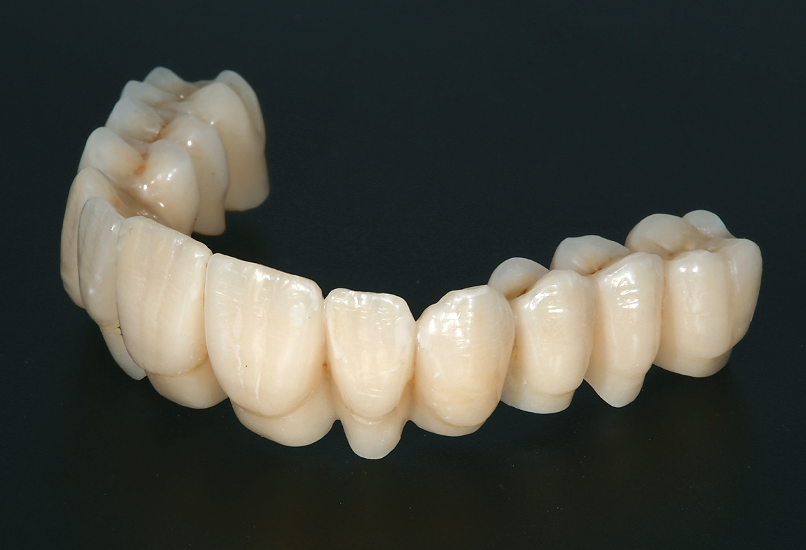 Abb. 18: Fertiggestelltes Oberkiefer-Langzeitprovisorium (Zahntechnik: Uli Schoberer Zahntechnik, Seehausen und GL Dental, Penzberg).