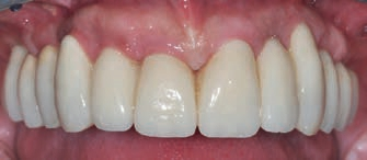 Abb. 20: Korrigierte Mittellinie, entzündungsfreie periimplantäre Gingiva. Der vertikale Verlust der Gingivahöhe in Richtung apikal an 13 und 23 war aufgrund des bereits stark abgebauten Knochenniveaus der Ausgangssituation zu erwarten.
