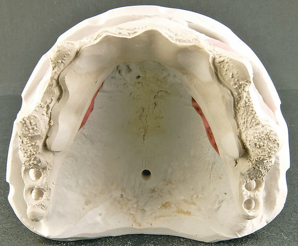 Abb. 85: Das Gerüst wurde aus einem PEEK-Material (BioHPP, bredent) gepresst. Nach unserer Erfahrung bietet dieses Gerüstmaterial für die Patienten einen angenehmen Tragekomfort und es besitzt eine knochenähnliche Biegefestigkeit. Allerdings ist auf eine ausreichende Dimensionierung zu achten, um dem Werkstoff die notwendige Stabilität zu verleihen.