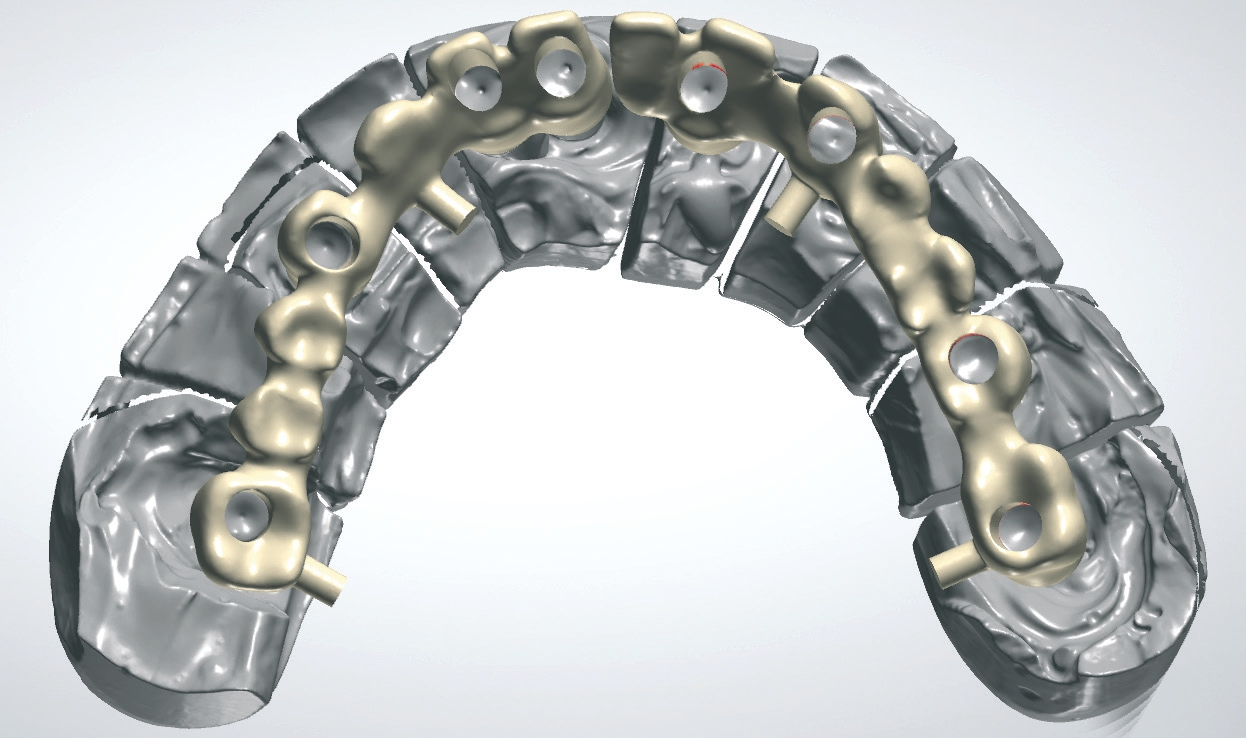 Abb. 18: Nach Modellherstellung CAD/CAM generierte Zirkongerüste – okklusale Ansicht.