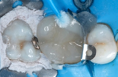 Abb. 20: Mit einem als Modellierinstrument verwendeten neuen Microbrush wird das Füllungsmaterial sorgfältig an die okklusale Kante der Keramikteilkrone adaptiert.