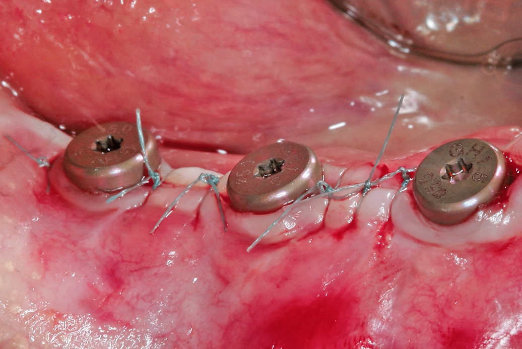 Abb. 20: … und die Weichgewebe wurden um die Gingivaformer reponiert und mit nicht resorbierbarem Nahtmaterial der Stärke 5.0 vernäht.