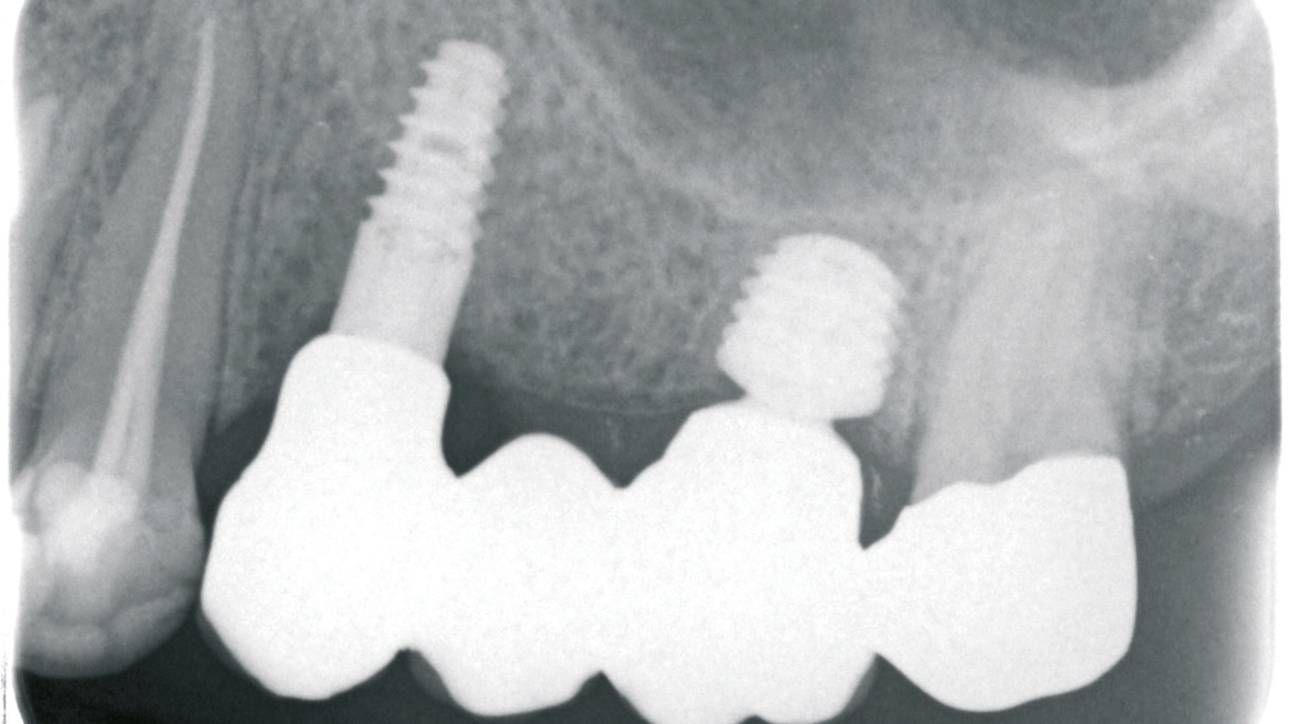 Abb. 18: Kontrolle der Brücke auf individualisierten Abutments.