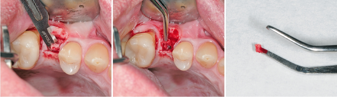 Abb. 17a bis c: Vorsichtiges Entfernen des Knochendeckels oberhalb des Implantates.
