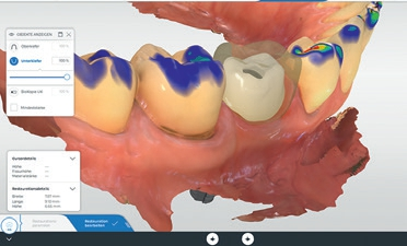 Abb. 18: Design der finalen Versorgung in der CEREC SW 5 (hier Abutment unter der Krone).