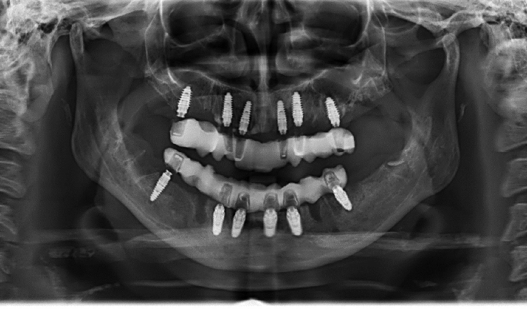 Abb. 18: Die postoperative Röntgenkontrolle zeigt keine Auffälligkeiten.
