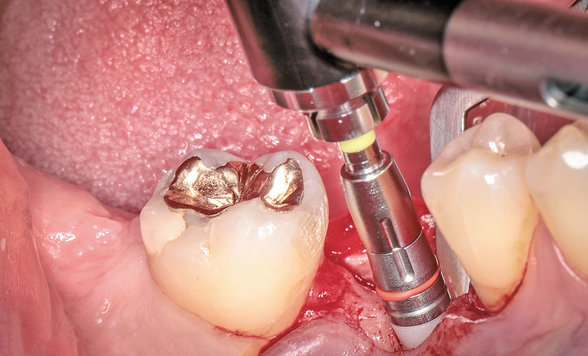 Abb. 18: Die Finalisierung des Implantatsitzes erfolgte ohne Bohrschablone.