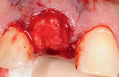 Abb. 17: Positionierung des Bindegewebstransplantats über dem Implantat und in der labial und oral präparierten Schleimhauttasche.