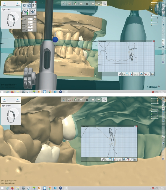 Abb. 23 u. 24: Konstruktion von zwei provisorischen Implantatkronen.