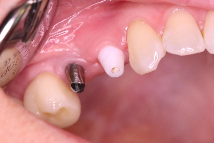 Abb. 18: Kontrolle nach Nahtentfernung eine Woche nach Implantation.