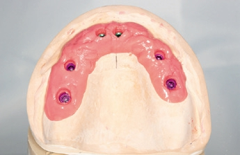Abb. 19: Gipsmodell mit Gingivamaske.