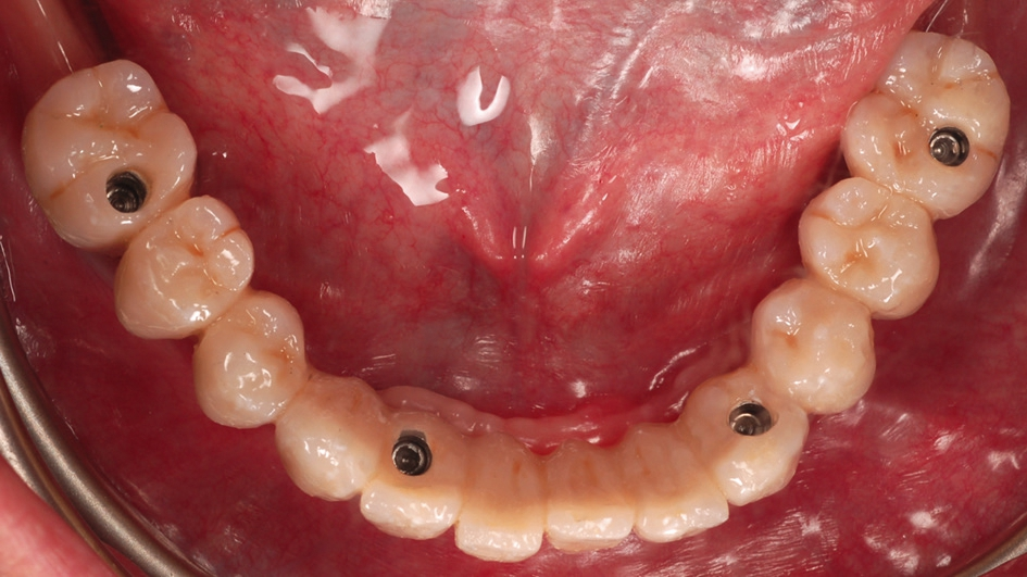 Abb. 19b: Verblendbrücke in situ.