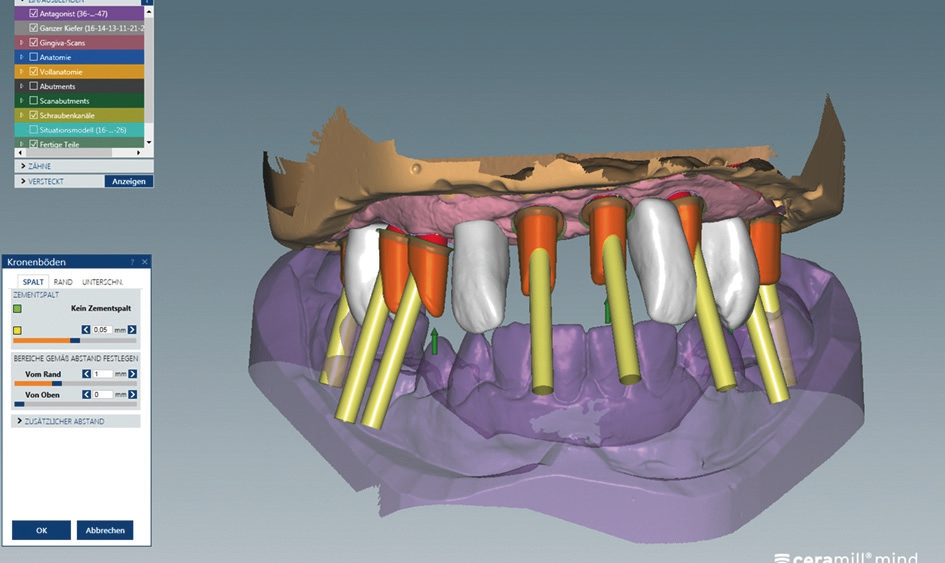 Abb. 19: Konstruktion der individuellen Abutments in Abhängigkeit von der Wachsaufstellung.