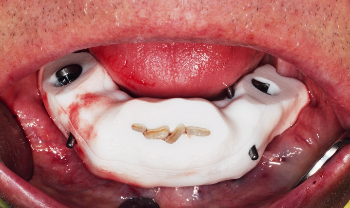 Abb. 19: OP-Schablone zur Insertion der distalen angulierten Implantate, auf Frontzähnen abgestützt.