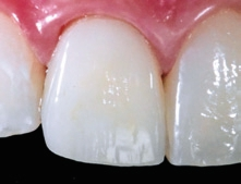 Abb. 19: Situation unmittelbar nach dem Einsetzen: gute farbliche Anpassung des Veneers. Der Bereich des Retraktionsfadens ist noch retrahiert, Zahn 21 erscheint aufgrund der Dehydrierung nach langer Trockenlegung etwas heller.