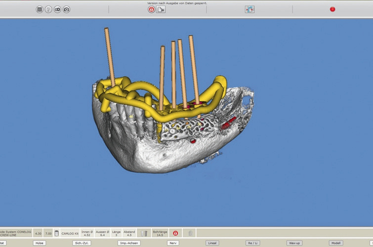 Abb. 19: Planung von vier Implantaten mittels SMOP.