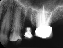 Abb. 19: Anhand der Relation zwischen Segment und interdentalem Limbus alveolaris ist das Ausmaß des Extrusion sehr gut zu erkennen (vgl. Abb. 18).