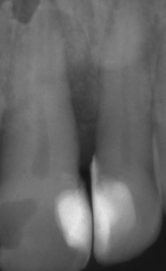 Abb. 19: Postoperative Röntgenkontrolle nach Augmentation.