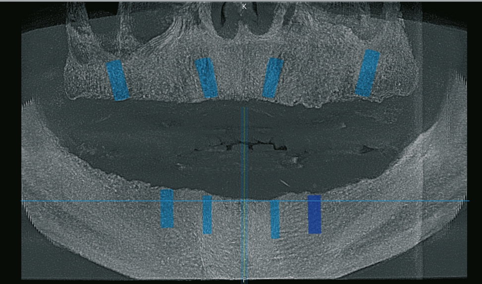 Abb. 19: OPG aus dem DVT mit den geplanten Implantaten.