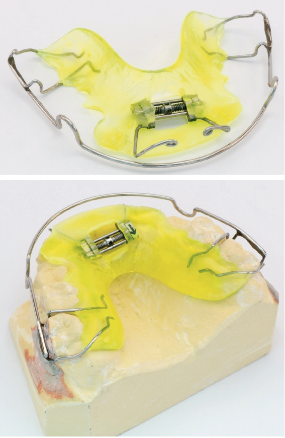 Abb. 66 u. 67: OK-Platte mit Diastemaschraube.